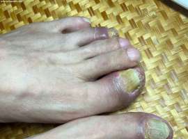 【求助】截至2024.8月一年半多使用k药，出现脚趾头手指头红肿。