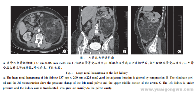 肾错构瘤的诊断与治疗1.png