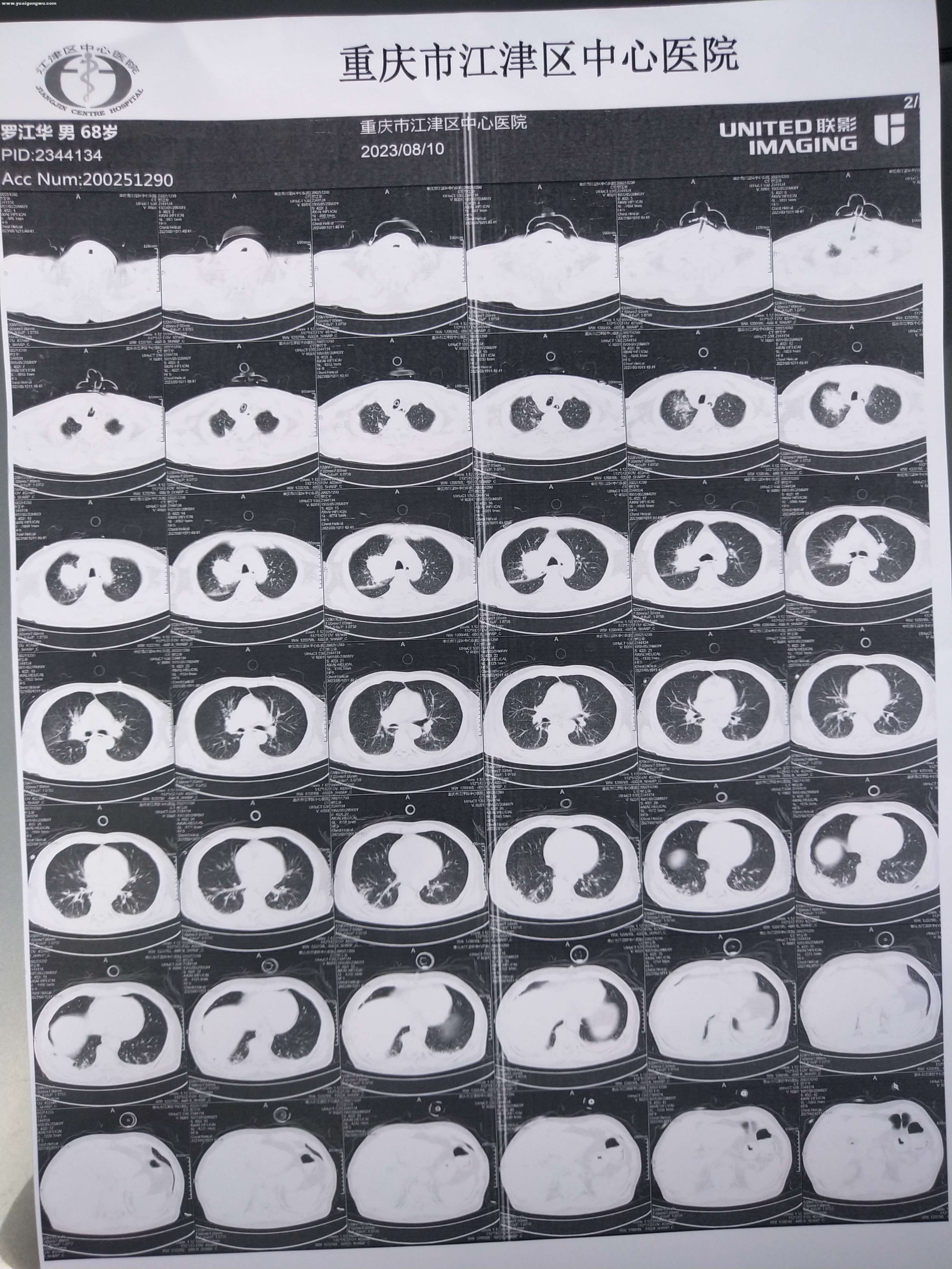 肺部CT8月10日a.jpg